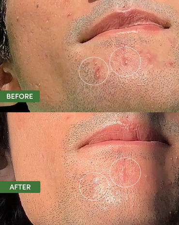 Oil Control Dual Action Blemish Patches